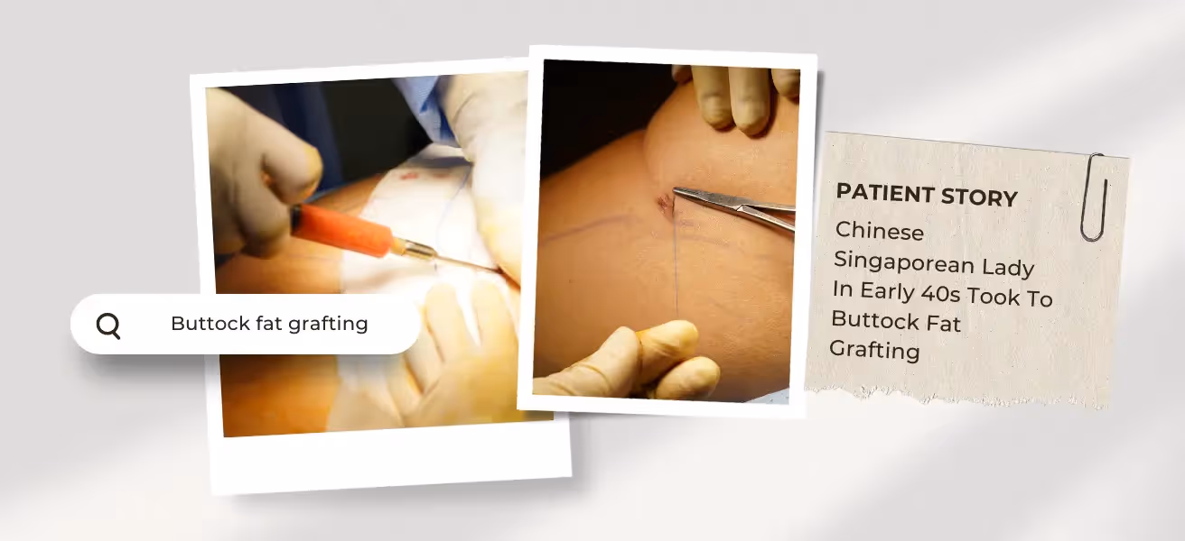 Buttock Fat Grafting