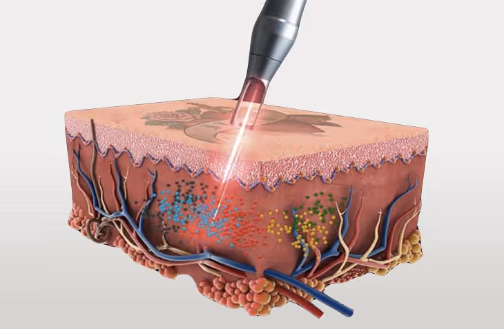 How to get your tattoo removed