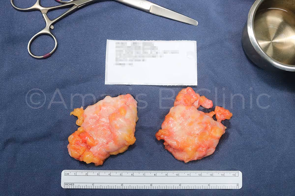 Glands of enlarged male breasts from a male patient, excised by Dr Ivan Puah