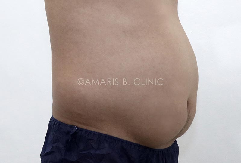 Image of a patient suffering from Paradoxical Adipose Hyperplasia (PAH) as a result of fat freezing.