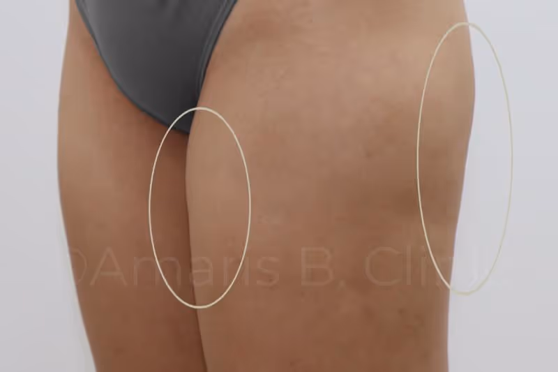 Botched liposuction: Uneven bumps on the thighs seen on a female patient
