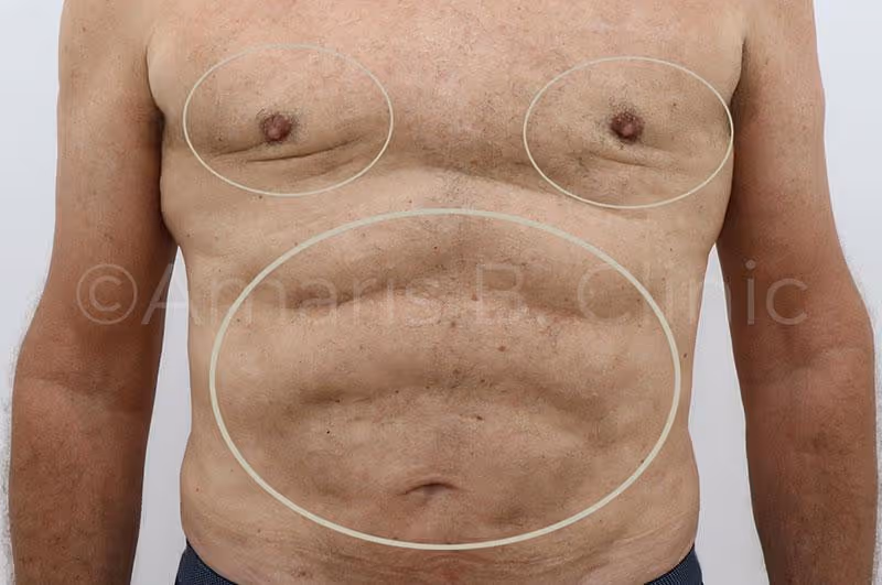 Male patient with severe dents on the chest. Botched Gynecomastia Surgery