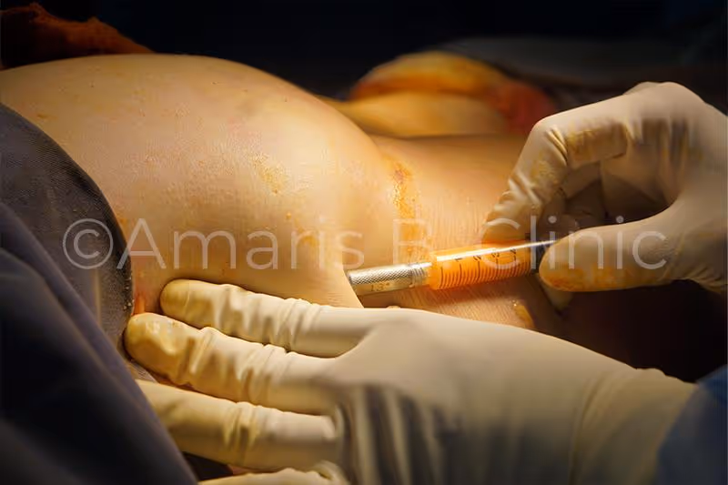 Buttock enhancement via fat transfer or fat grafting by Dr Ivan Puah