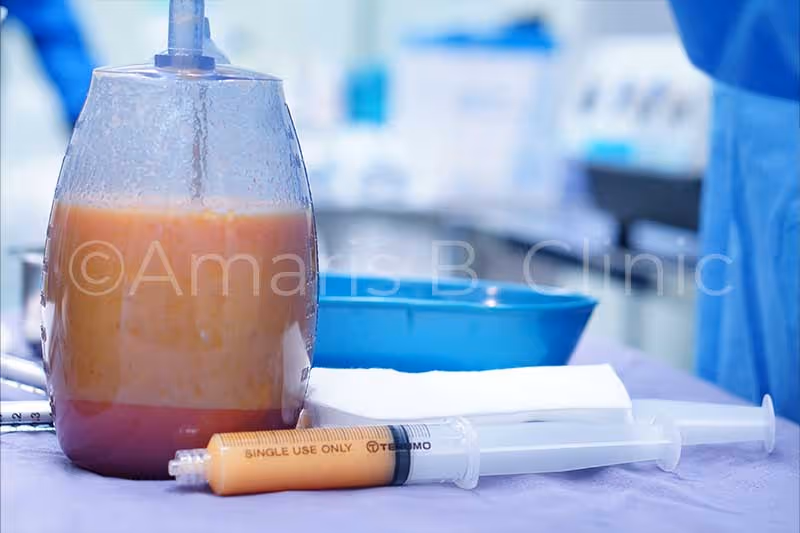 During a fat grafting procedure in Singapore conducted by Dr Ivan Puah