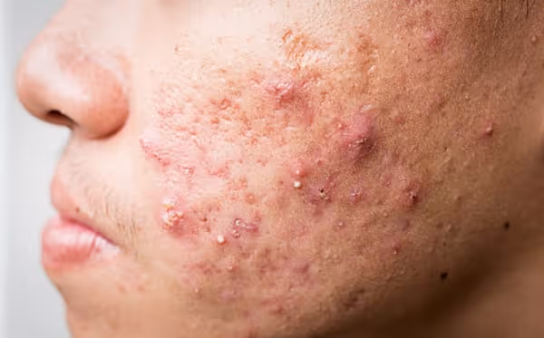 Acne and post-acne skin woes