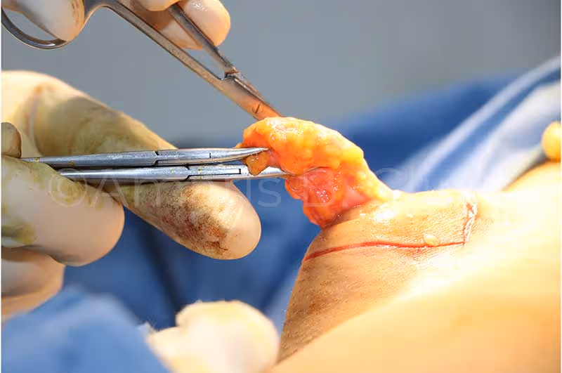 Accessory breast glands removed from the armpit in a patient by Dr Ivan Puah