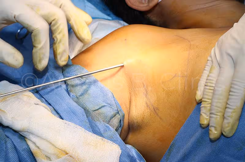 Liposuction doctor in Singapore, Dr Ivan Puah, during an armpit fat liposuction procedure