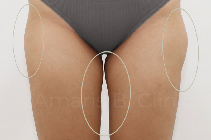 Liposuction Fat Inside Thighs Inner Thigh Fat Problems Reasons - Main Image