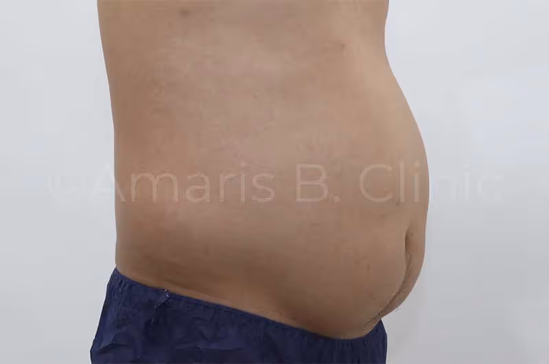 Male in his 40s who suffered from Paradoxical Adipose Hyperplasia went to seek corrective surgery with Dr Ivan Puah, Medical Director at Amaris B. Clinic. Circa 2017.