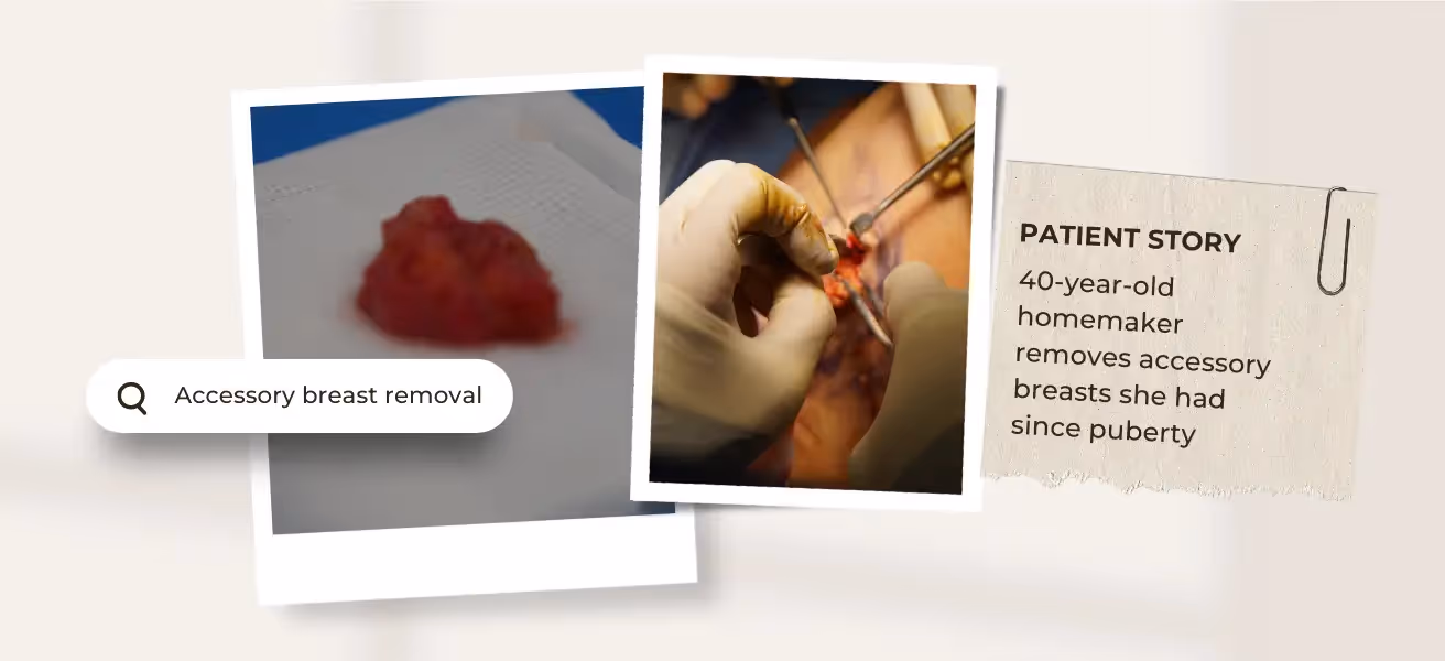 40-year-old homemaker struggled with armpit bulges since young. Dr Puah recommended a combi of axillary accessory breast removal surgery and armpit liposuction.