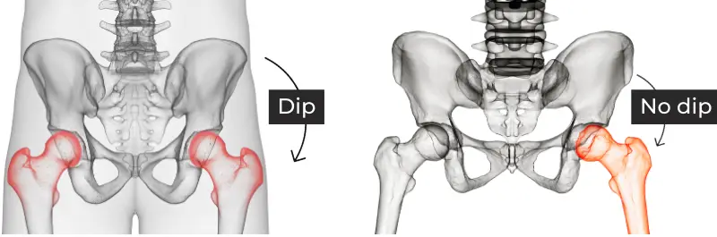 Hip Dips Explained How To Spot Them Causes Treatments Amaris B Clinic Hip Dips Explained How To Spot Them Causes Treatments Amaris B Clinic