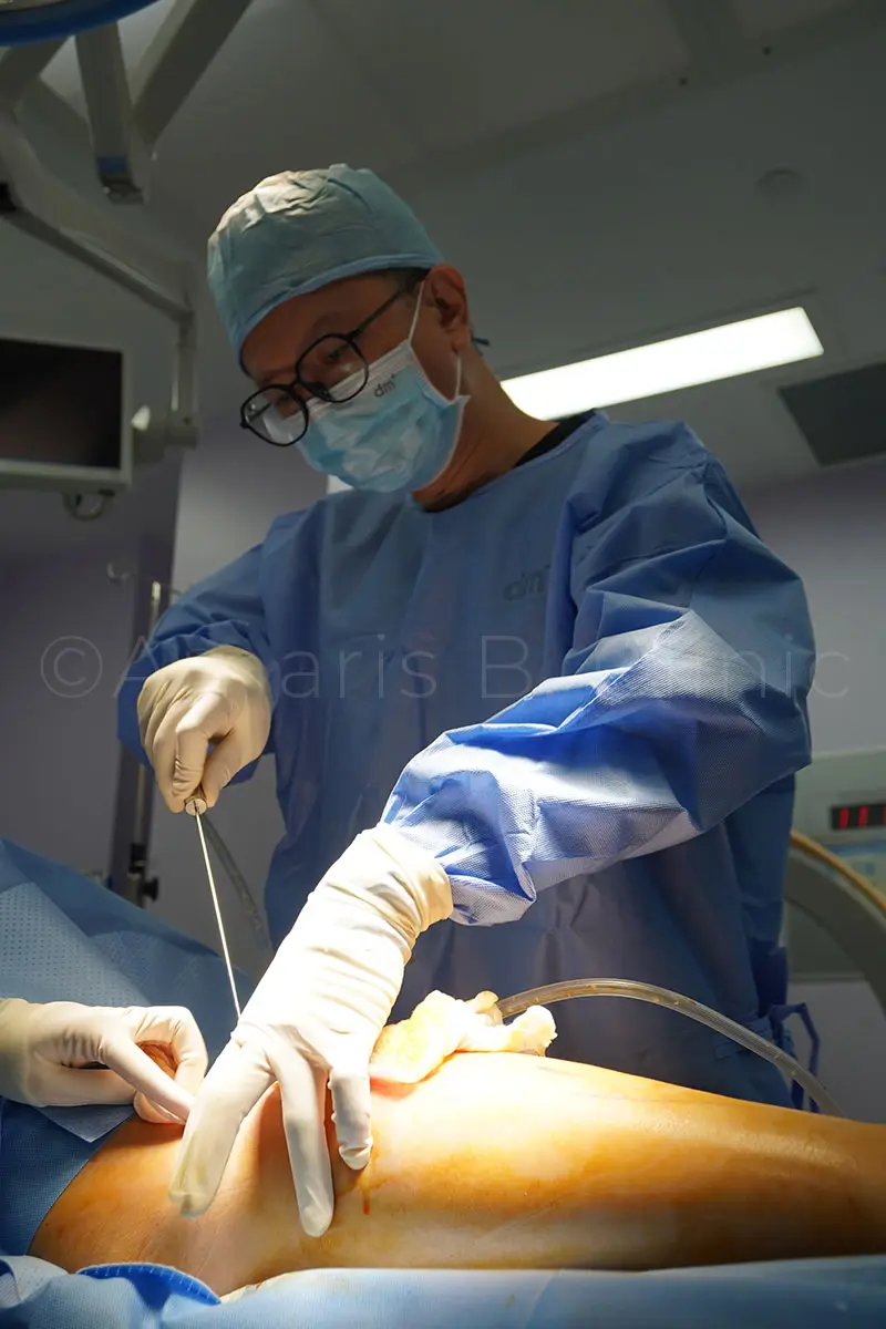 Indonesian Woman Underwent Lipedema Surgery On Hips, Thighs, Calves and Knees