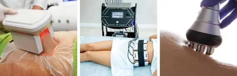 Cryolipolysis, laser lipolysis, and radiofrequency therapy