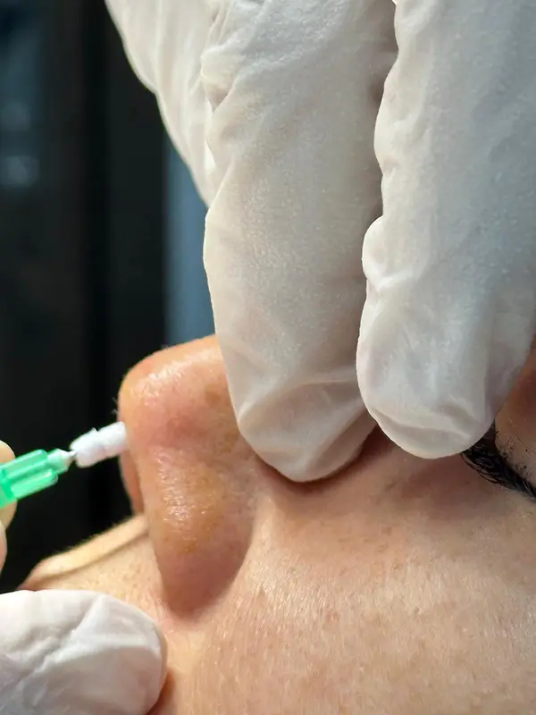 PDO Threadlift Nose Augmentation