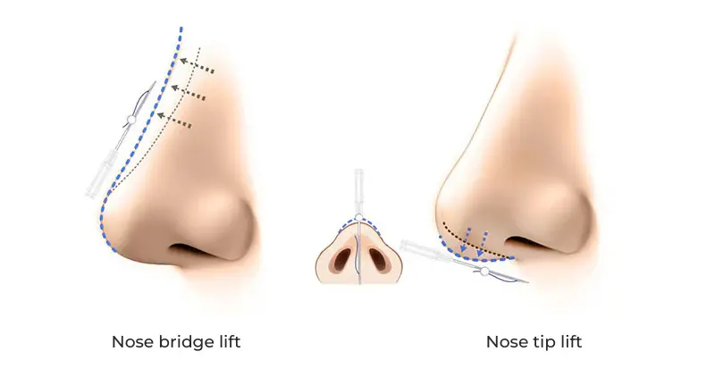 Nose Augmentation vector