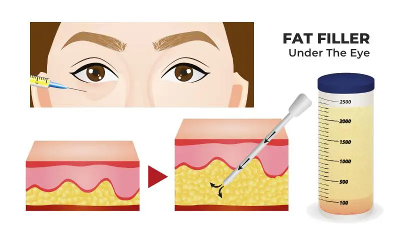 Undereye Fat Transfer