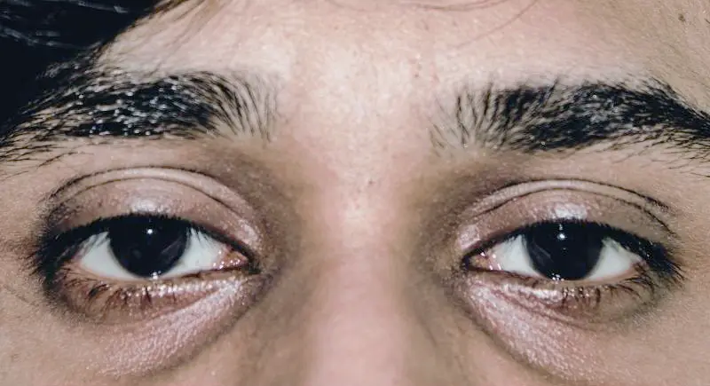 Dark Circles & Tear Troughs: Responsible For Making You Look Aged