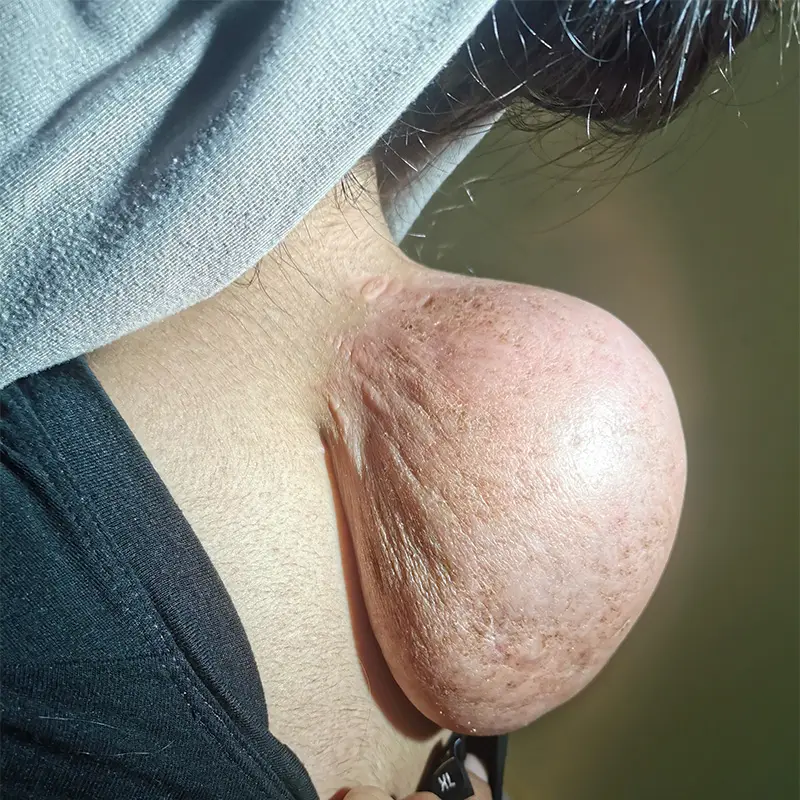 accessory breast tissue mimicking