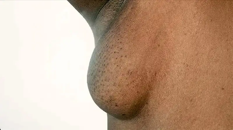 accessory breast tissue