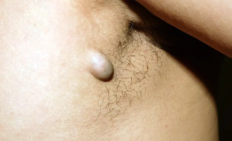 accessory breast tissue mimicking