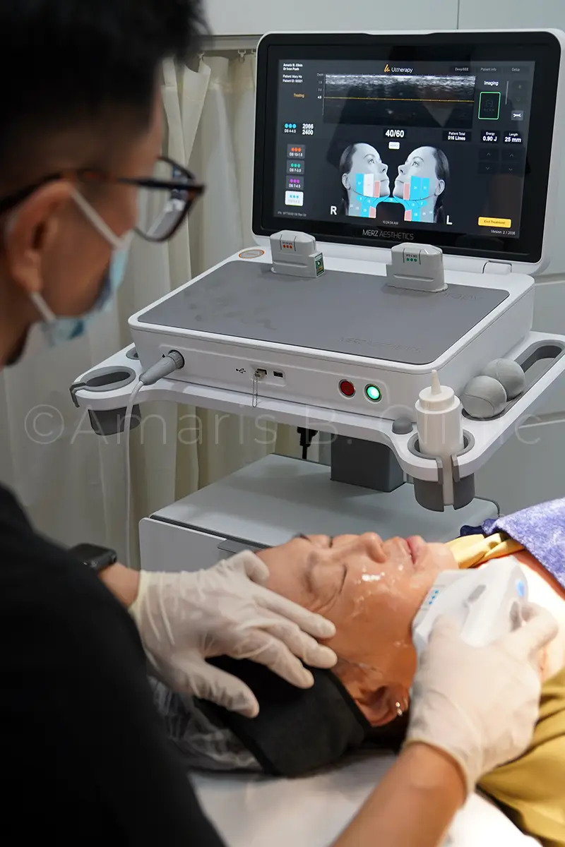 68 year-old retiree reversed facial ageing signs with Ultherapy Prime 