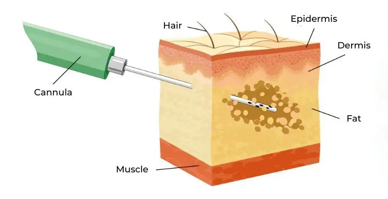 Liposuction vector