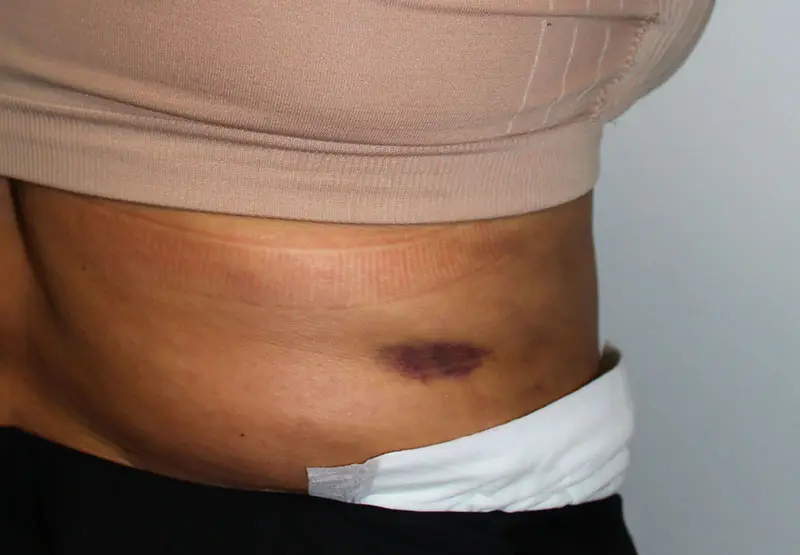 liposuction Risks, Side Effects