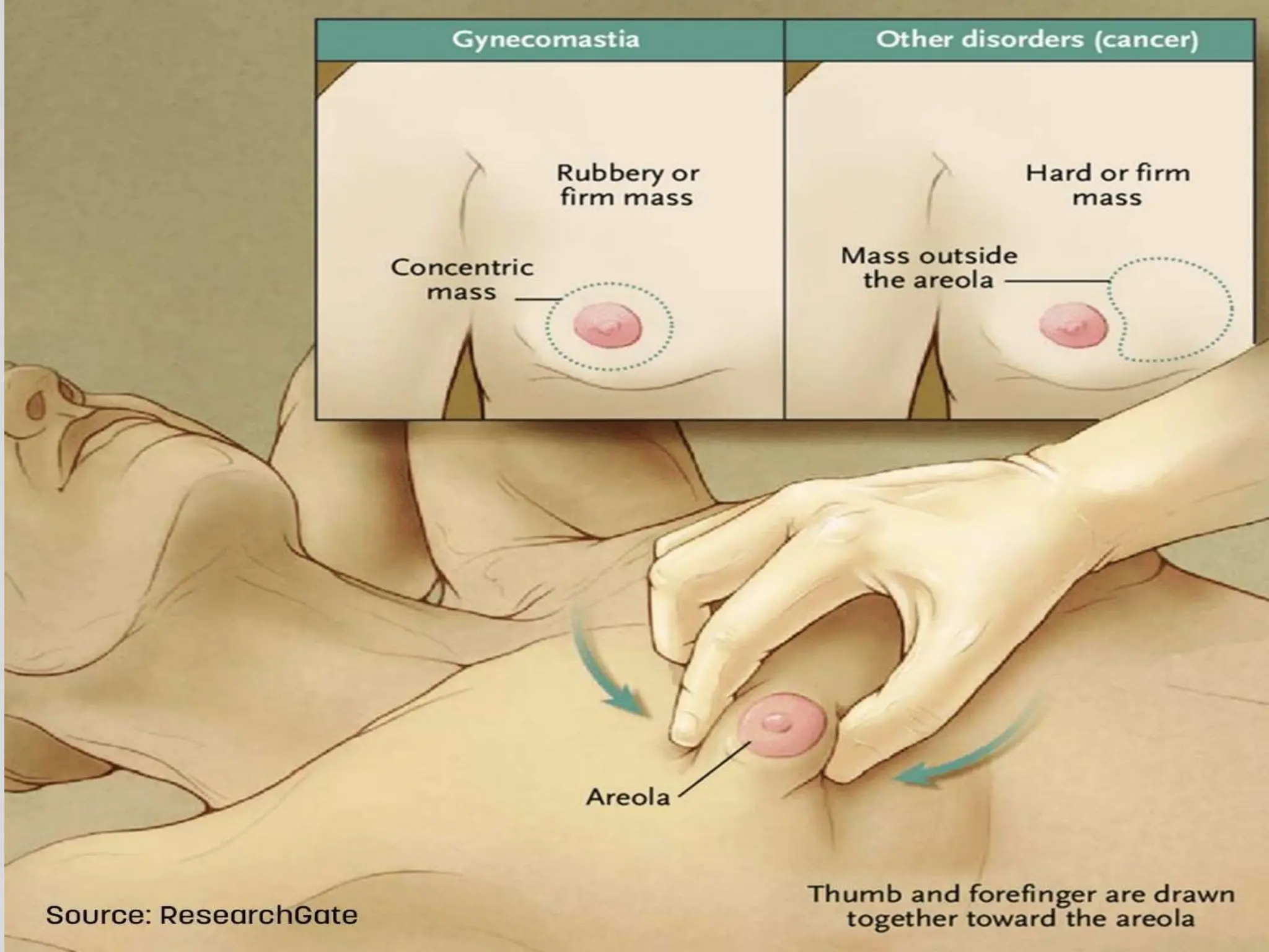 Gynecomastia & Pseudogynecomastia Differences