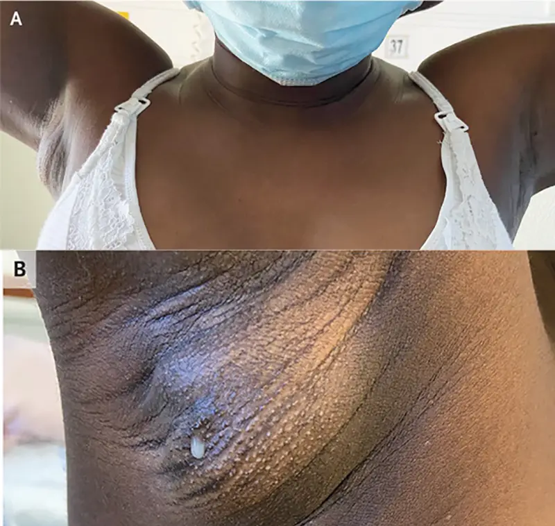 Lactating accessory breast