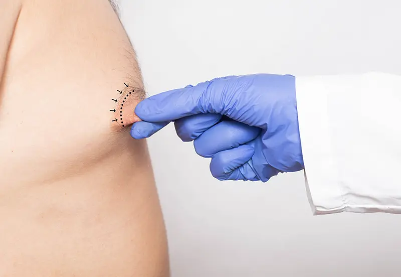 Nipple surgery