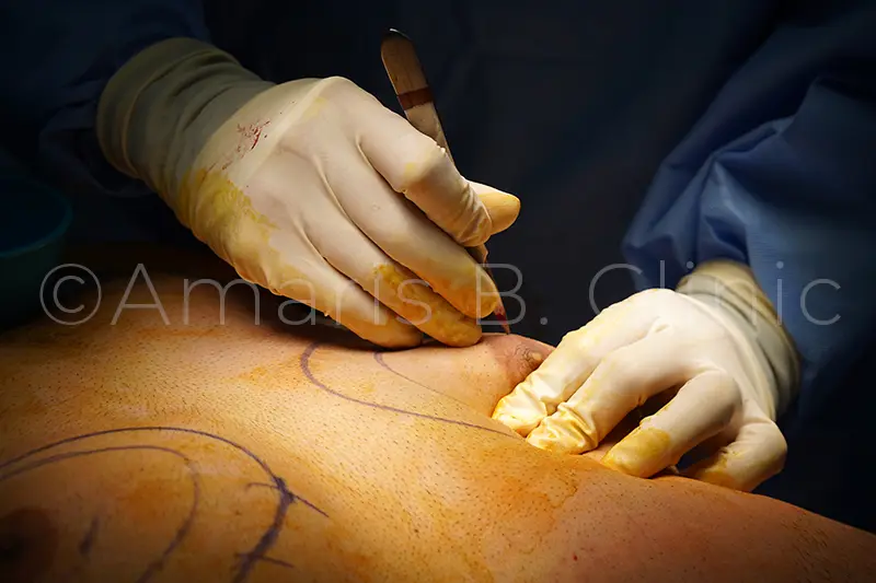 Gynecomastia surgery
