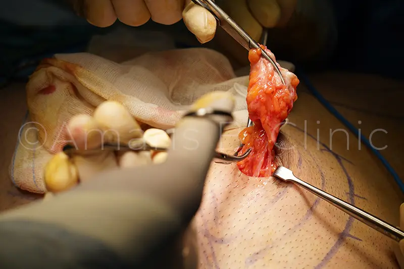 Gynecomastia surgery