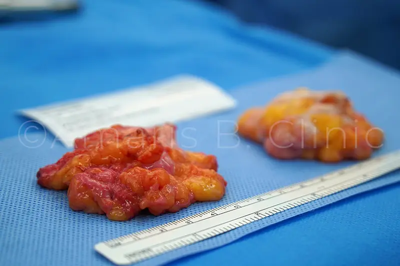 Gynecomastia surgery glands