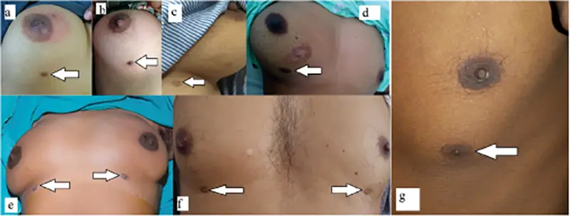 Accessory breast Singapore Dr Ivan Puah Amaris B. Clinic