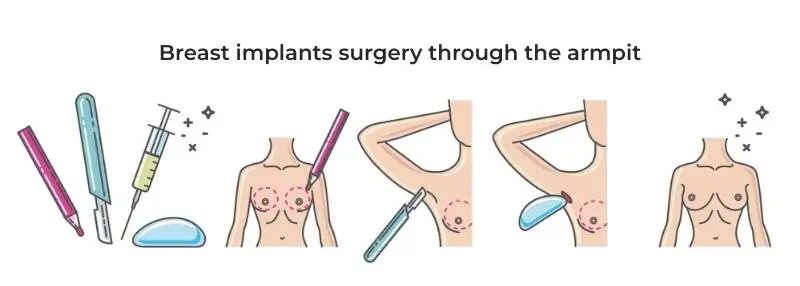 Breast implants surgery through the armpit