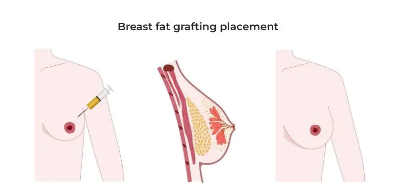 Breast fat grafting placement