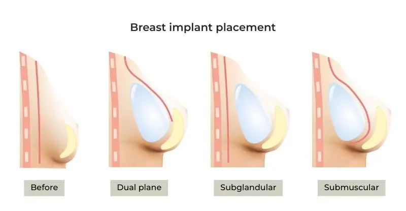 Breast implant placement