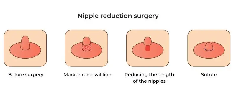 Male Nipple Reduction Surgery