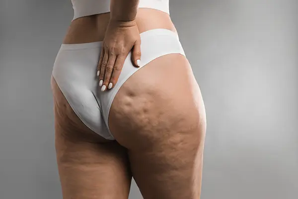 Cellulite Treatment