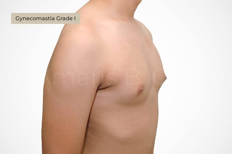 Grade 1 gynecomastia mild puffy nipple appearance male chest