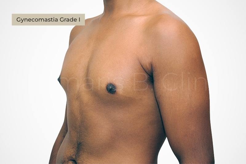 Grade 1 gynecomastia mild puffy nipple appearance male chest