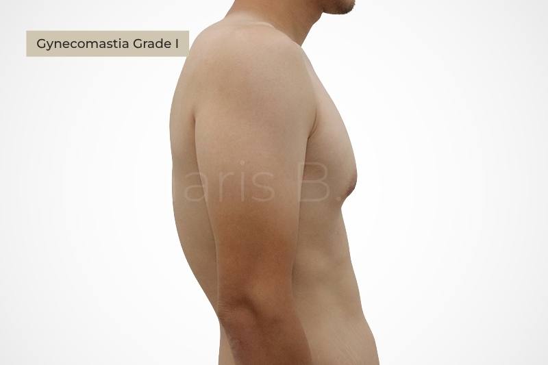 Grade 1 gynecomastia mild puffy nipple appearance male chest
