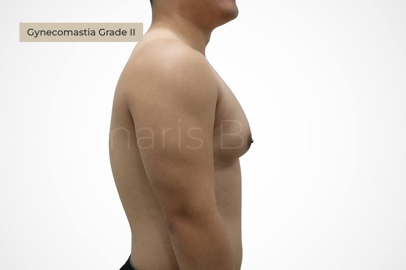 Grade 2 moderate gynecomastia chest enlargement male