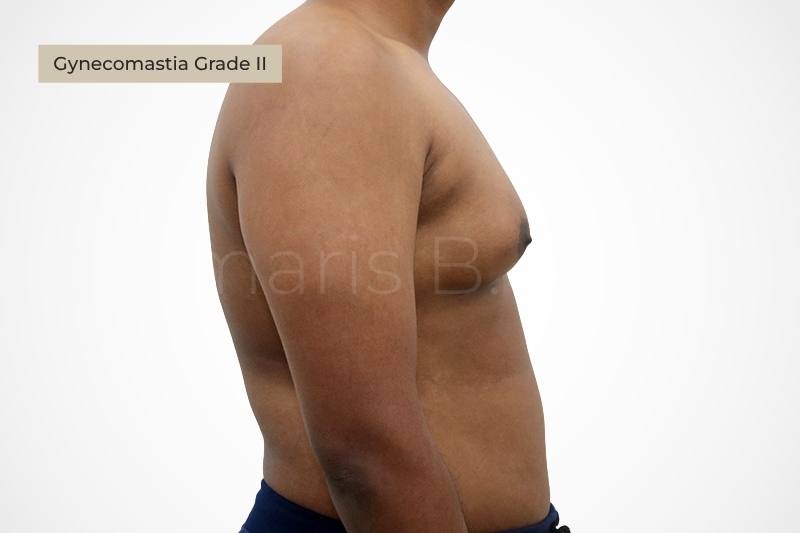 Grade 2 moderate gynecomastia chest enlargement male