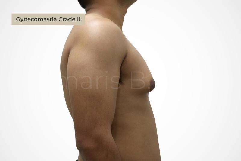 Grade 2 moderate gynecomastia chest enlargement male