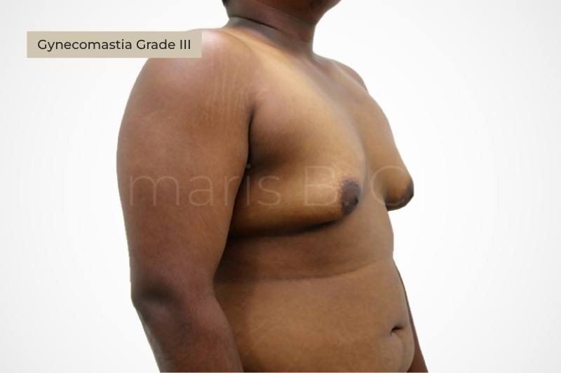 Grade 3 severe gynecomastia resembling female breast male chest