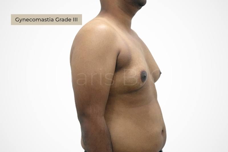 Grade 3 severe gynecomastia resembling female breast male chest