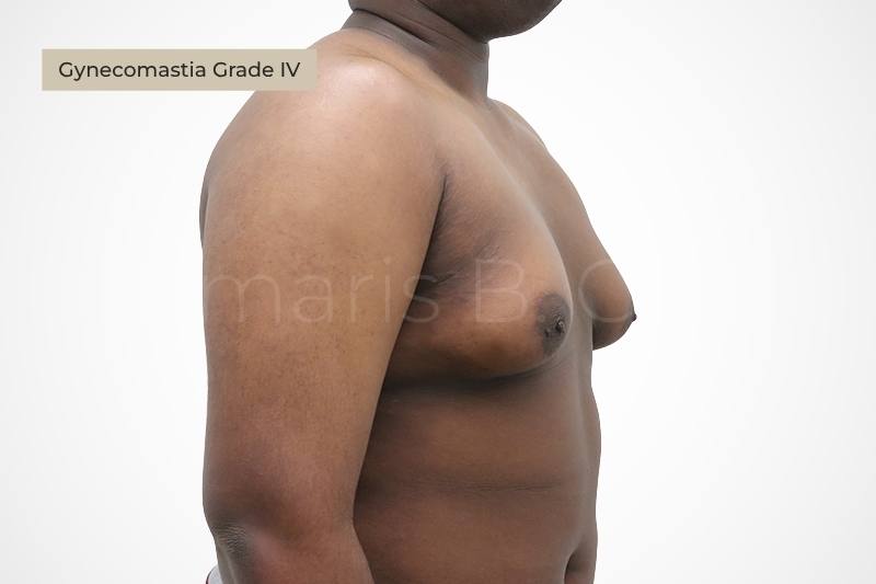 Grade 4 severe gynecomastia excess skin ptosis male chest