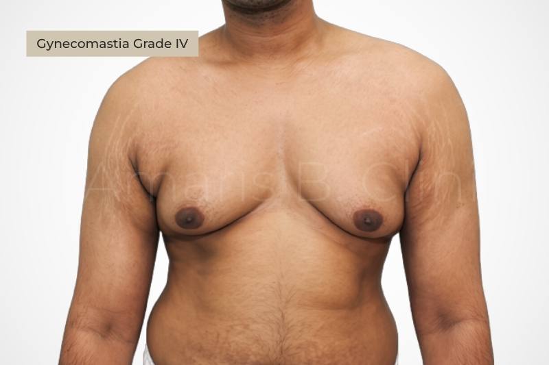 Grade 4 severe gynecomastia excess skin ptosis male chest