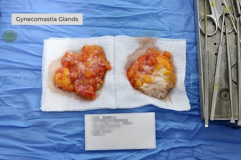 Gynecomastia Glands